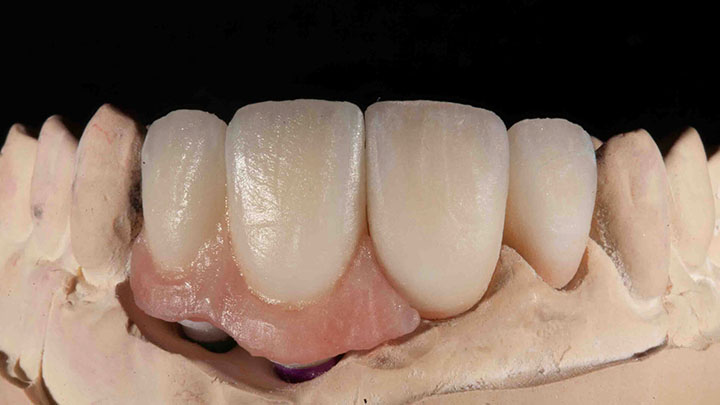 Pink Porcelain Placement