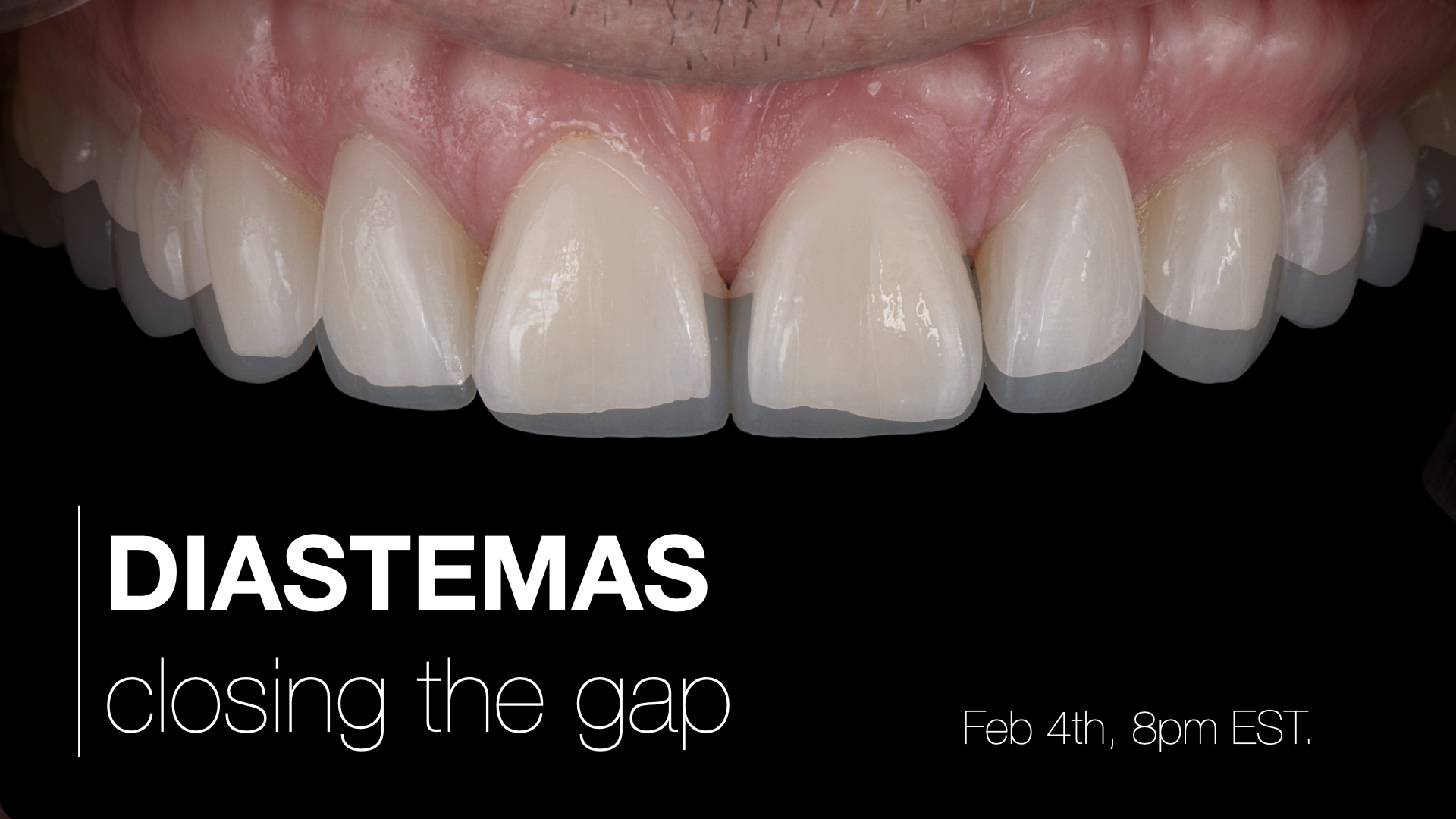 Diastemas: Closing the Gap
